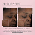 Before and after results of using SkinMedica Pore Purifying Gel Cleanser