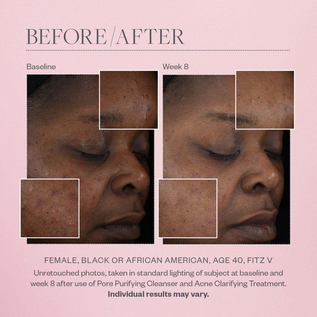 Before and after results of using SkinMedica Pore Purifying Gel Cleanser