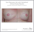 Before and after results of using SkinMedica Scar Recovery Gel with Centelline
