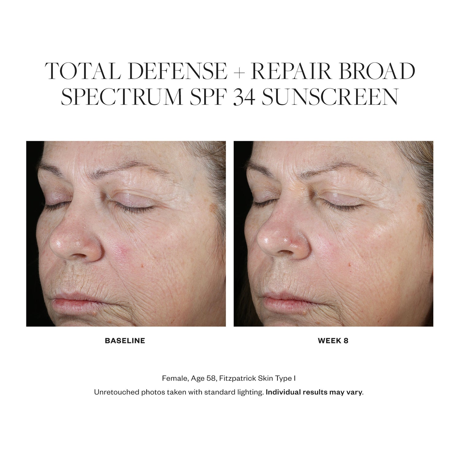 Before and after results of using SkinMedica Total Defense + Repair Broad Spectrum SPF 34 Sunscreen