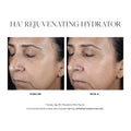 Before and after results of using SkinMedica HA5 Rejuvenating Hydrator