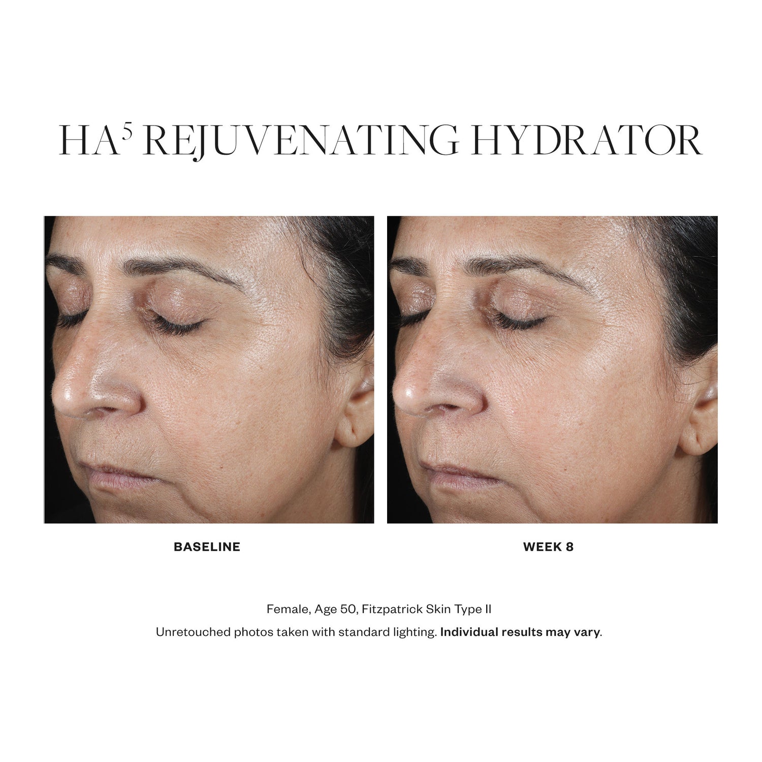 Before and after results of using SkinMedica HA5 Rejuvenating Hydrator