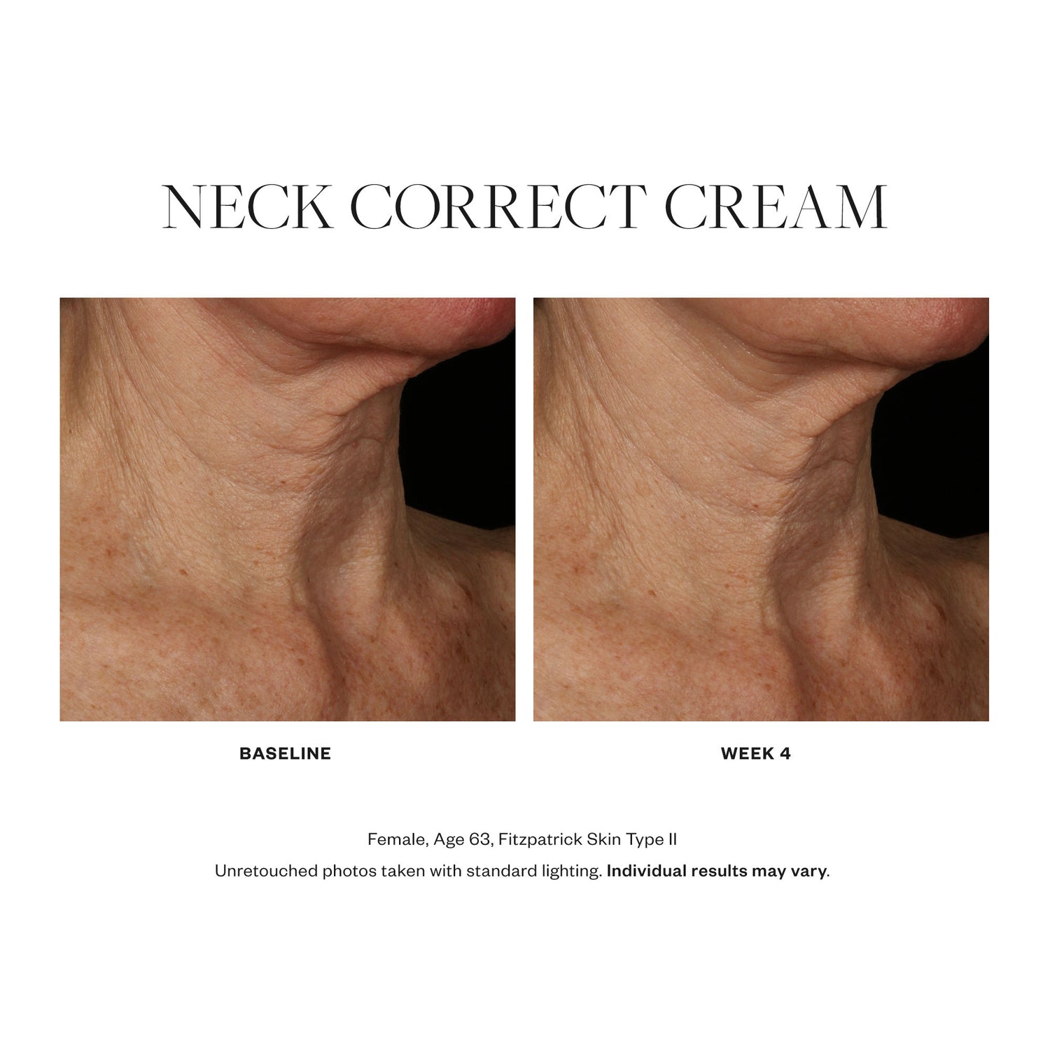 Before and after results of using SkinMedica Neck Correct Cream