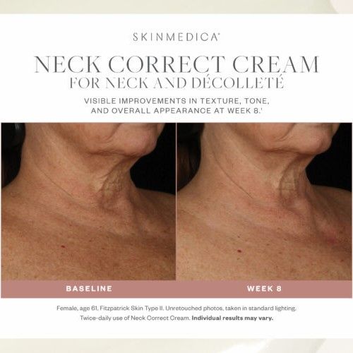 Before and after results of using SkinMedica Neck Correct Cream