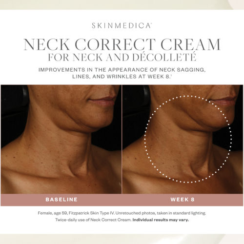 Before and after results of using SkinMedica Neck Correct Cream