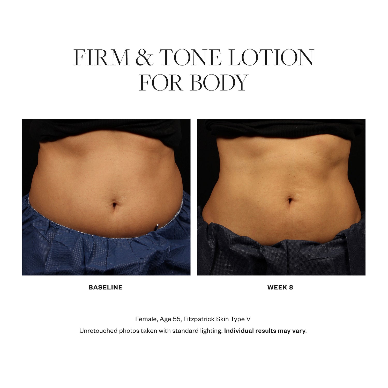 Before and after results of using SkinMedica Firm & Tone Lotion For Body