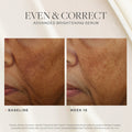 Before and after results of using SkinMedica Even & Correct Advanced Brightening Treatment