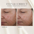 Before and after results of using SkinMedica Even & Correct Advanced Brightening Treatment