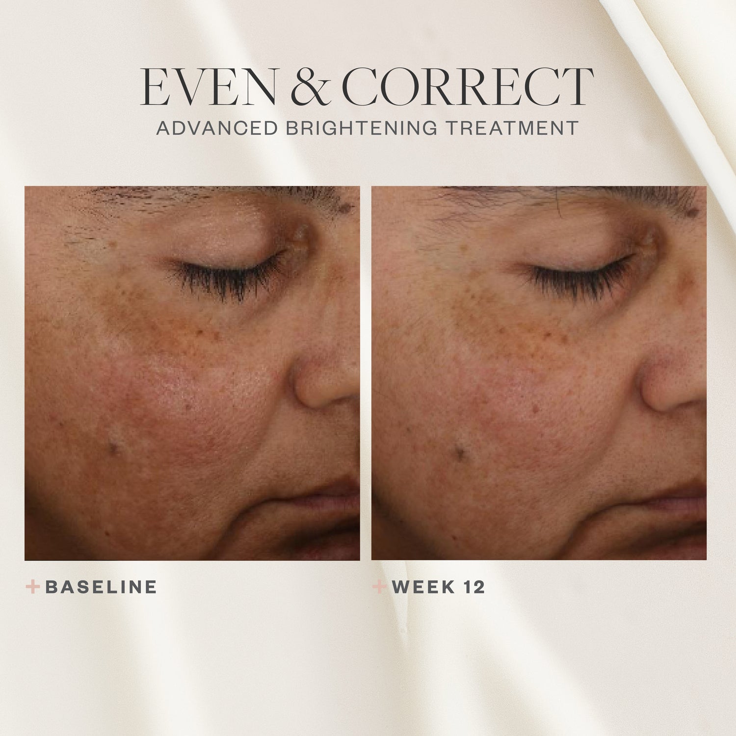 Before and after results of using SkinMedica Even & Correct Advanced Brightening Treatment