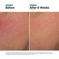 Before and after results of using SkinCeuticals Glycolic 10 Renew Overnight