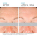 Before and after results of using SkinCeuticals A.G.E. Interrupter Advanced