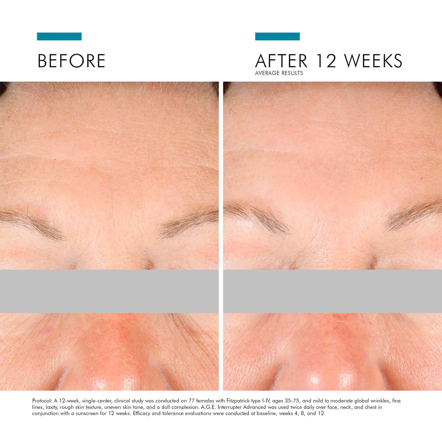 Before and after results of using SkinCeuticals A.G.E. Interrupter Advanced