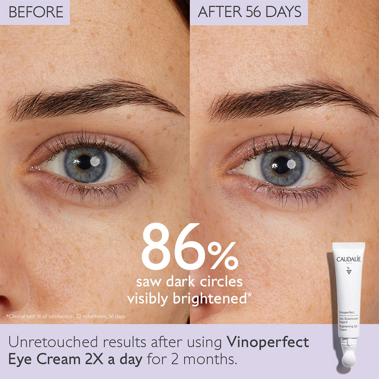 Before and after results of using Caudalie Vinoperfect Dark Circle Brightening Eye Cream