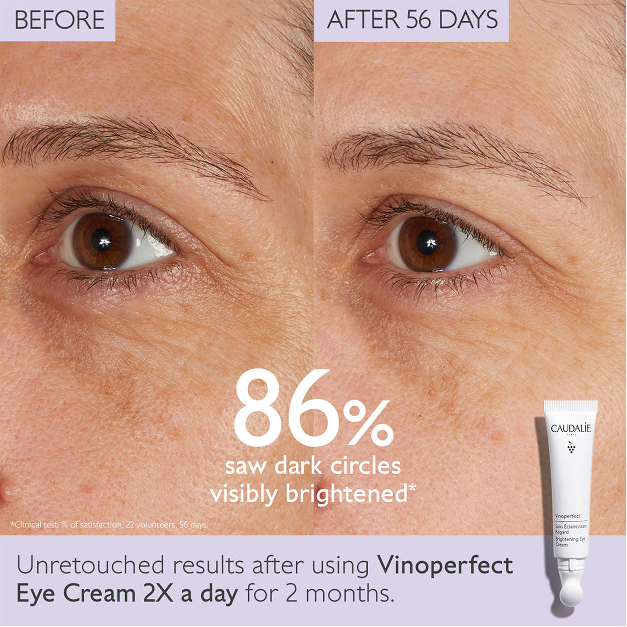 Before and after results of using Caudalie Vinoperfect Dark Circle Brightening Eye Cream