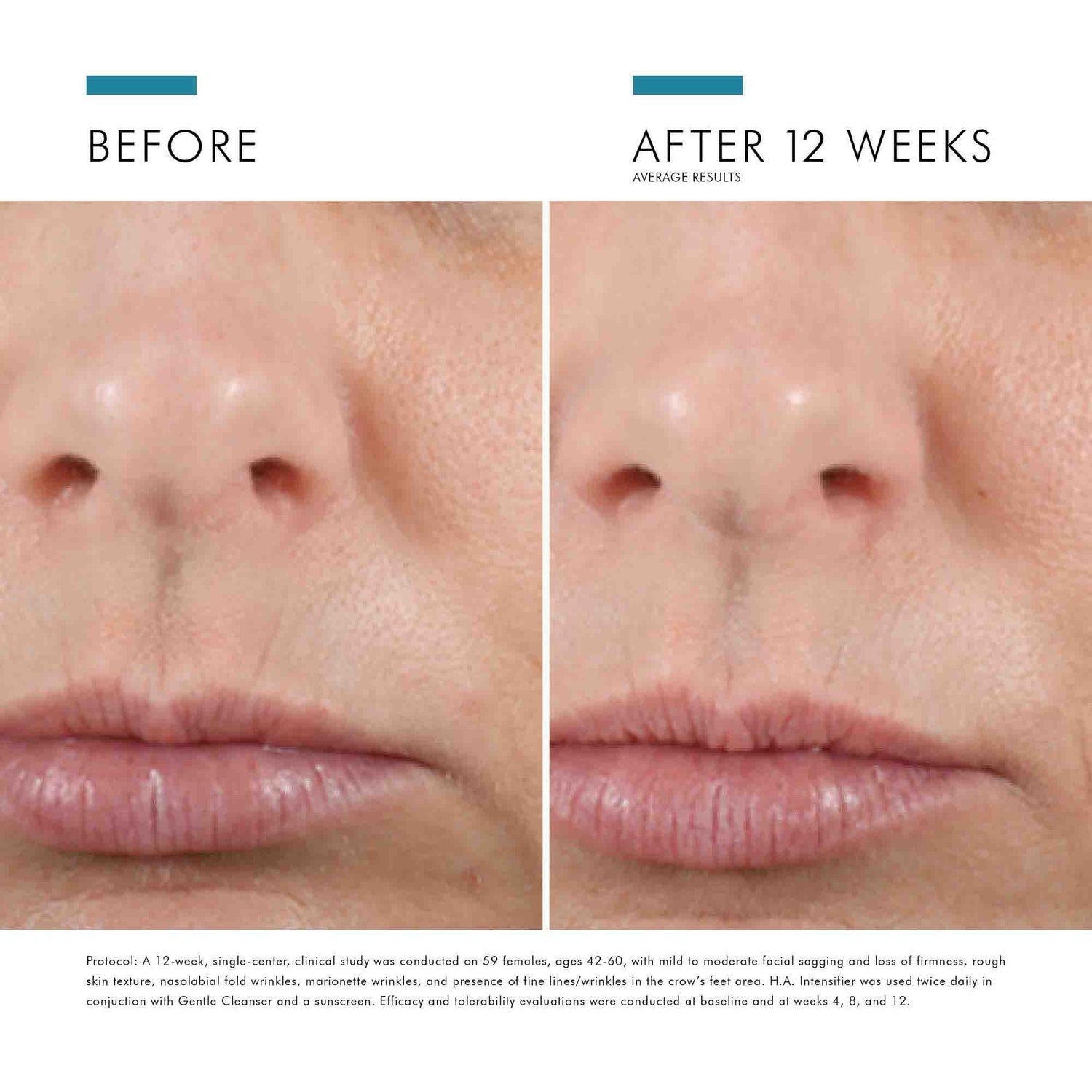 Before and after results of using SkinCeuticals H.A. Intensifier