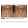 Before and after results of using SkinCeuticals Tripeptide-R Neck Repair