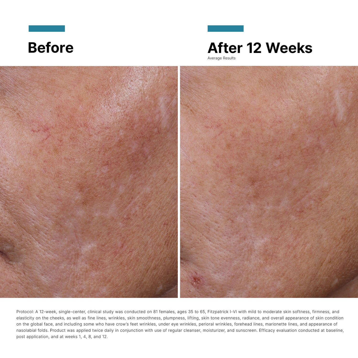 Before and after results of using SkinCeuticals HA Intensifier Multi-Glycan