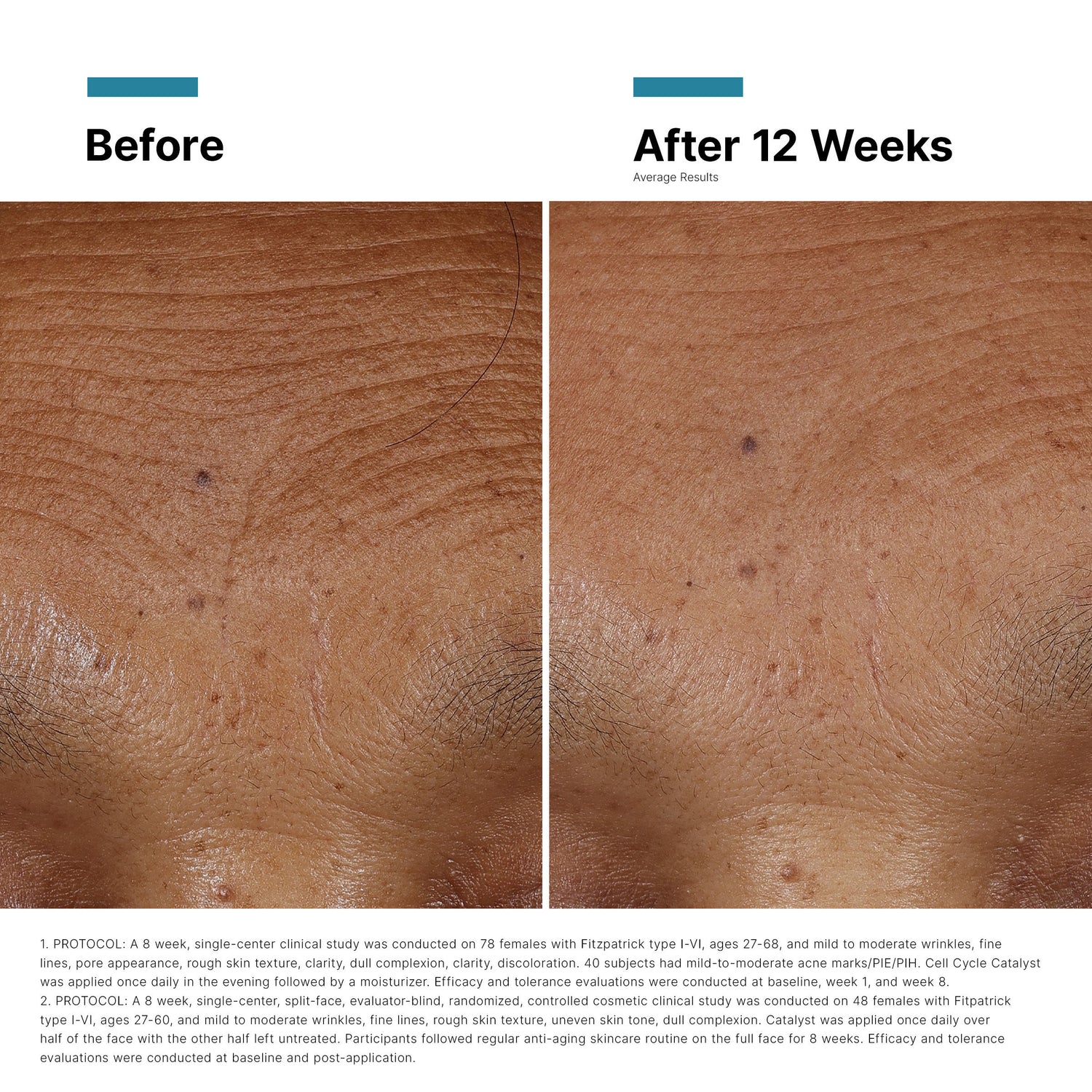 Before and after results of using SkinCeuticals HA Intensifier Multi-Glycan