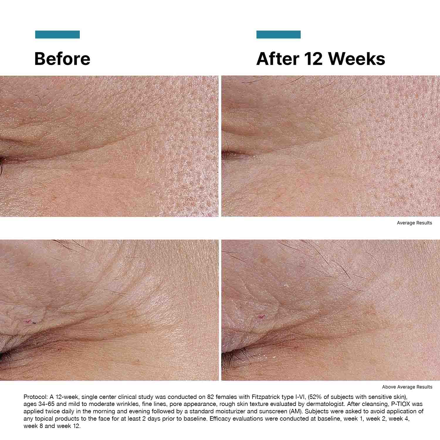 Before and after results of using SkinCeuticals P-TIOX