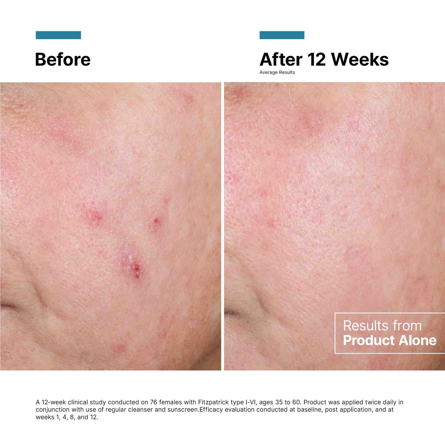 Before and after results of using SkinCeuticals Advanced RGN-6 Regenerative Cream