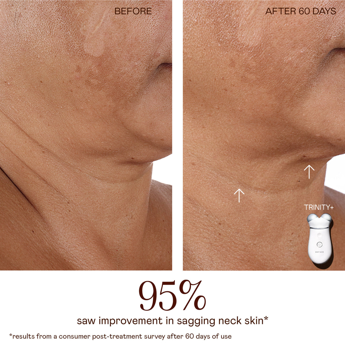 Before and after results of using NuFace TRINITY+ Starter Kit | Lift & Tighten Facial Microcurrent Device