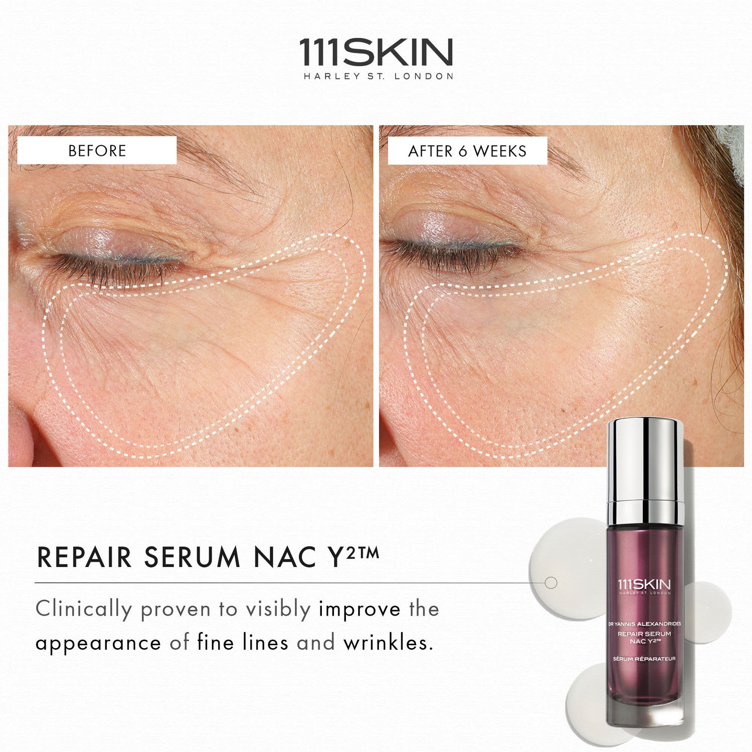 Before and after results of using 111SKIN Repair Serum NAC Y2