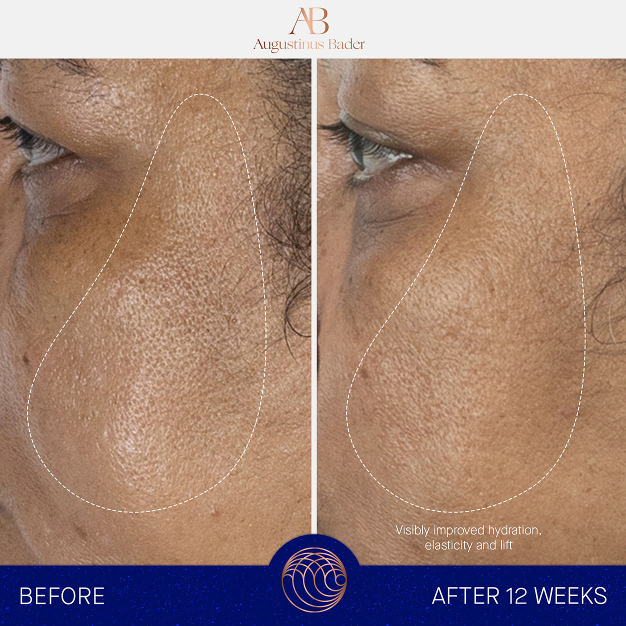 Before and after results of using Augustinus Bader The Serum Nomad