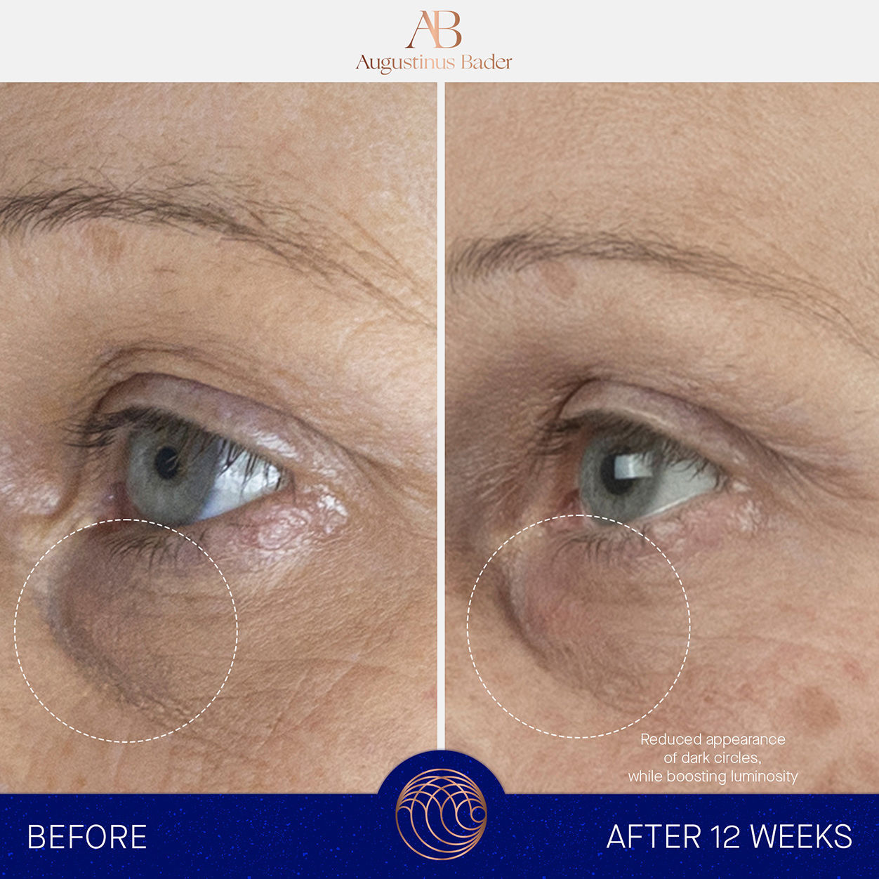 Before and after results of using Augustinus Bader The Eye Cream