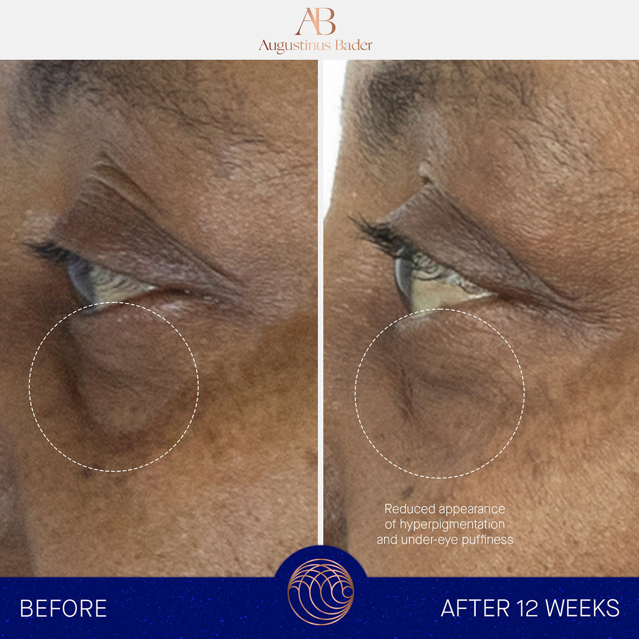 Before and after results of using Augustinus Bader The Eye Cream