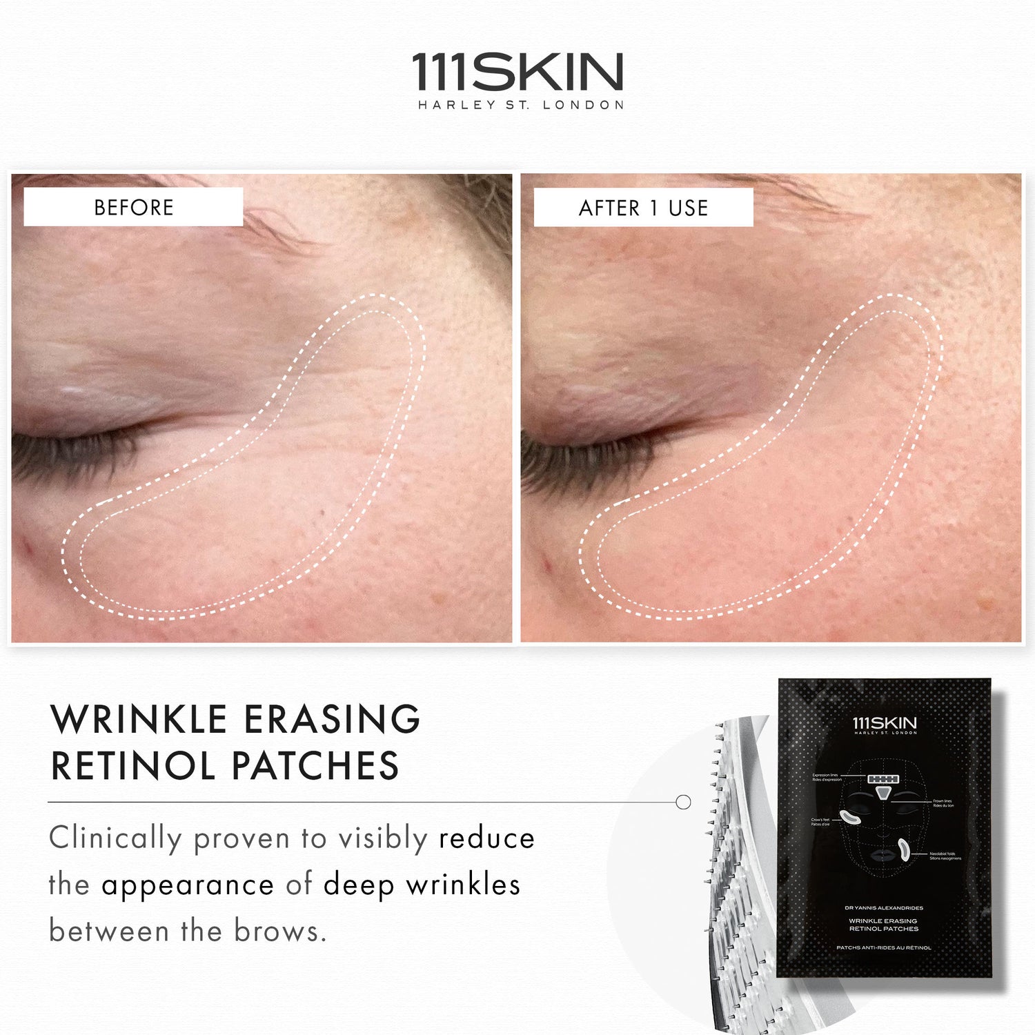 Before and after results of using 111SKIN Wrinkle Erasing Retinol Patches