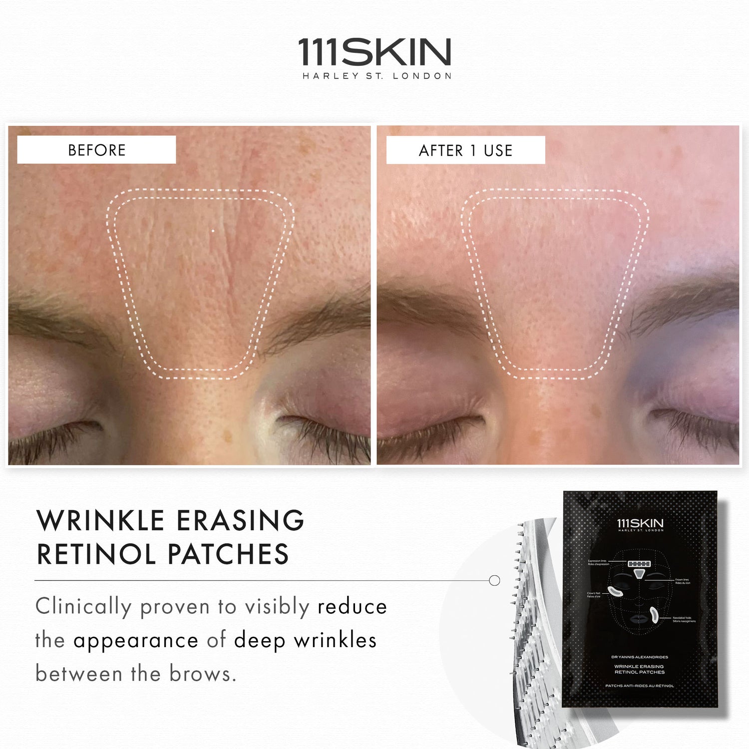 Before and after results of using 111SKIN Wrinkle Erasing Retinol Patches