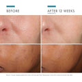 Before and after results of using SkinCeuticals Phloretin CF