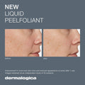 Before and after results of using Dermalogica Liquid Peelfoliant