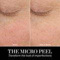 Before and after results of using La Mer The Micro Peel