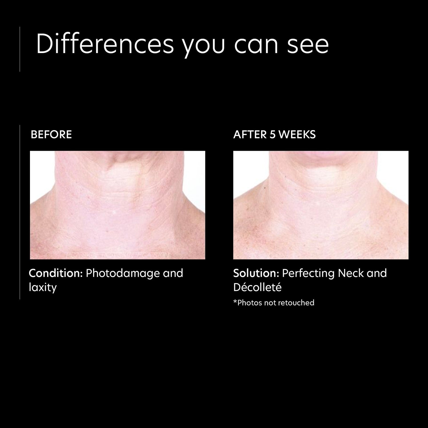 Before and after results of using PCA Skin Perfecting Neck and Decollete