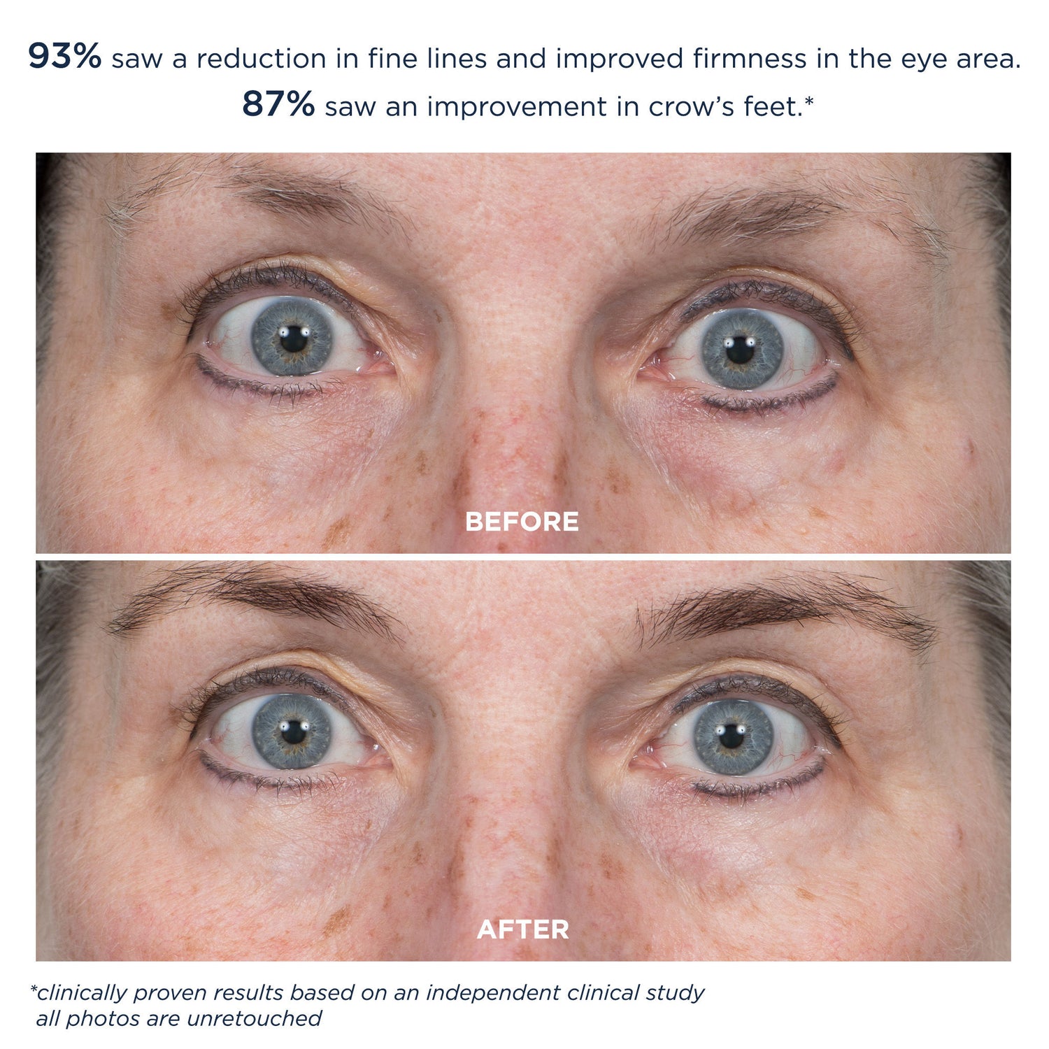 Before and after results of using M-61 ProSmooth Retinol Eye Serum