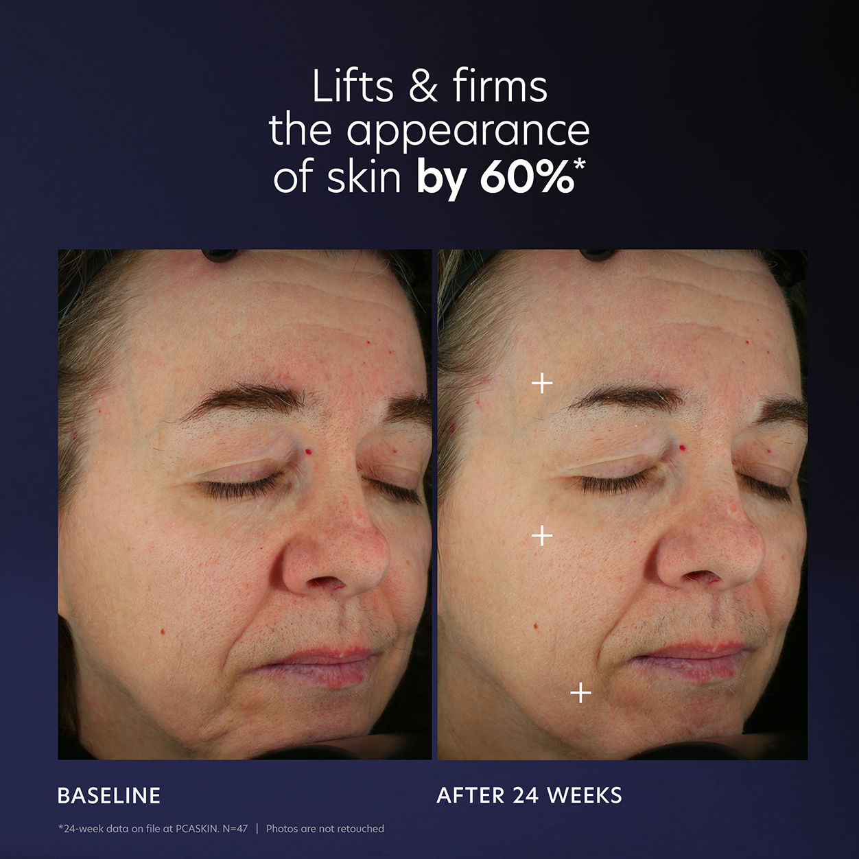 Before and after results of using PCA Skin Pro-Max Age Renewal