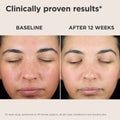 Before and after results of using EltaMD UV Skin Recovery Broad Spectrum SPF 50