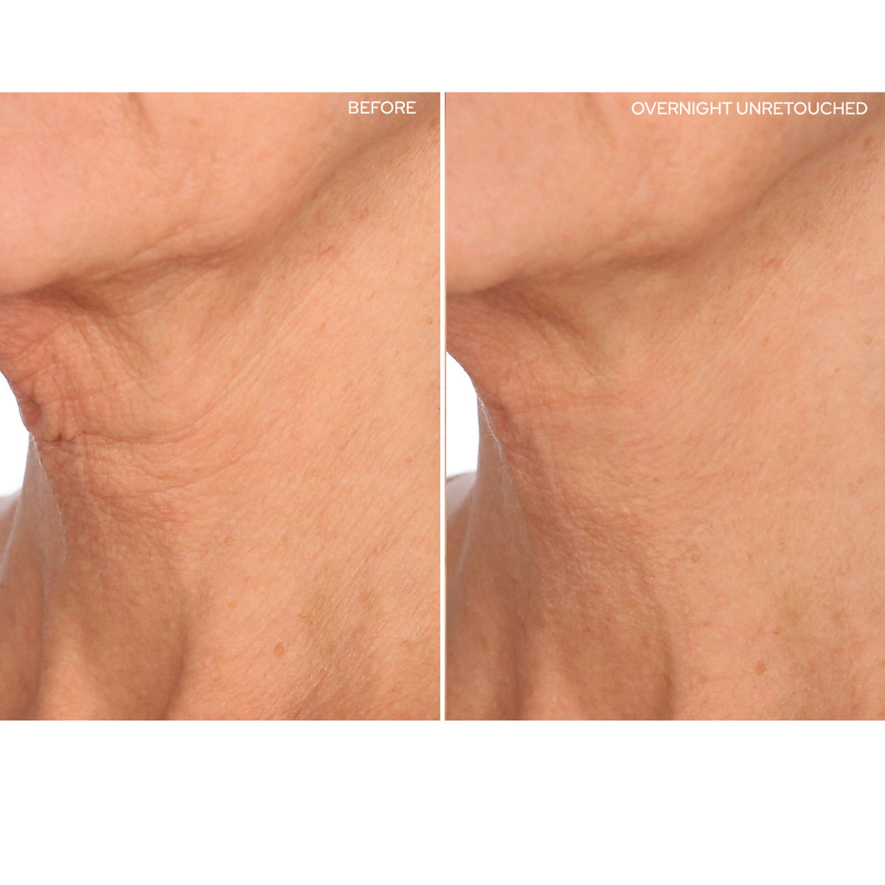 Before and after results of using SIO FaceLift