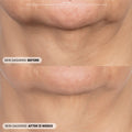 Before and after results of using Dr. Whitney Bowe Beauty Procedure Enhancement Program
