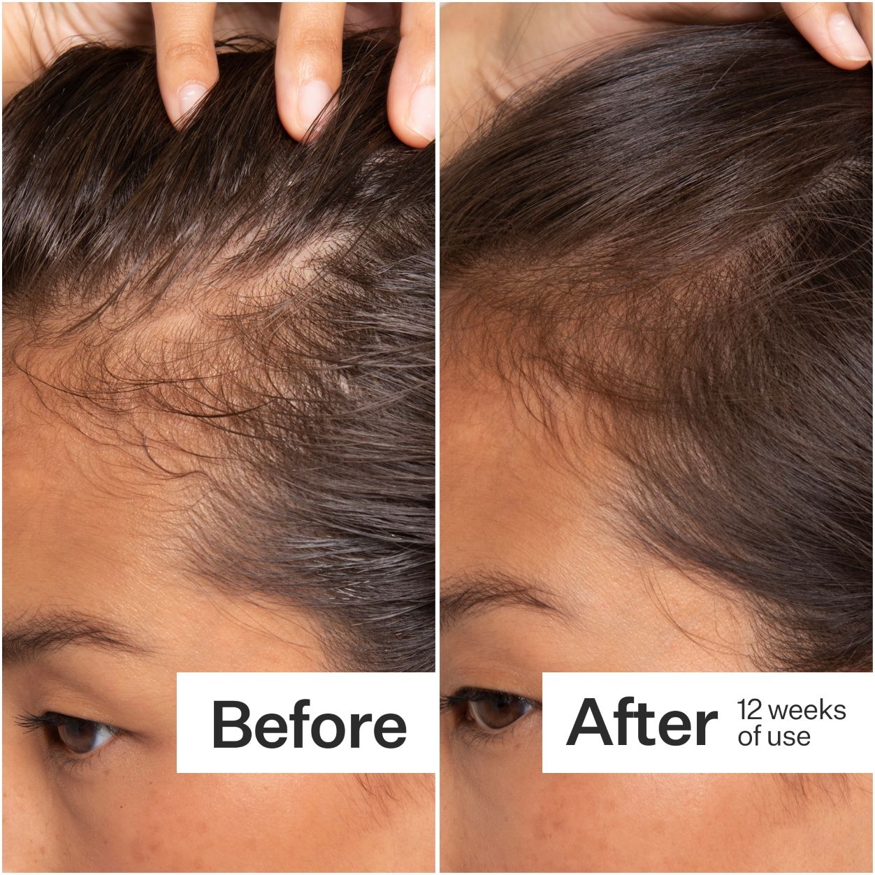 Before and after results of using Act+Acre Cold Processed Stem Cell Serum