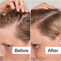 Before and after results of using Act+Acre Salicylic Acid Scalp Exfoliator