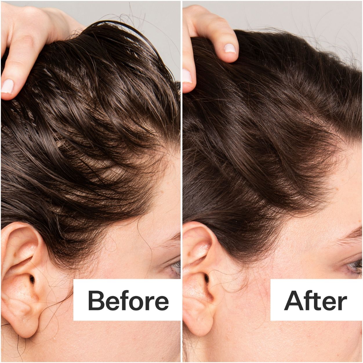 Before and after results of using Act+Acre Salicylic Acid Scalp Exfoliator