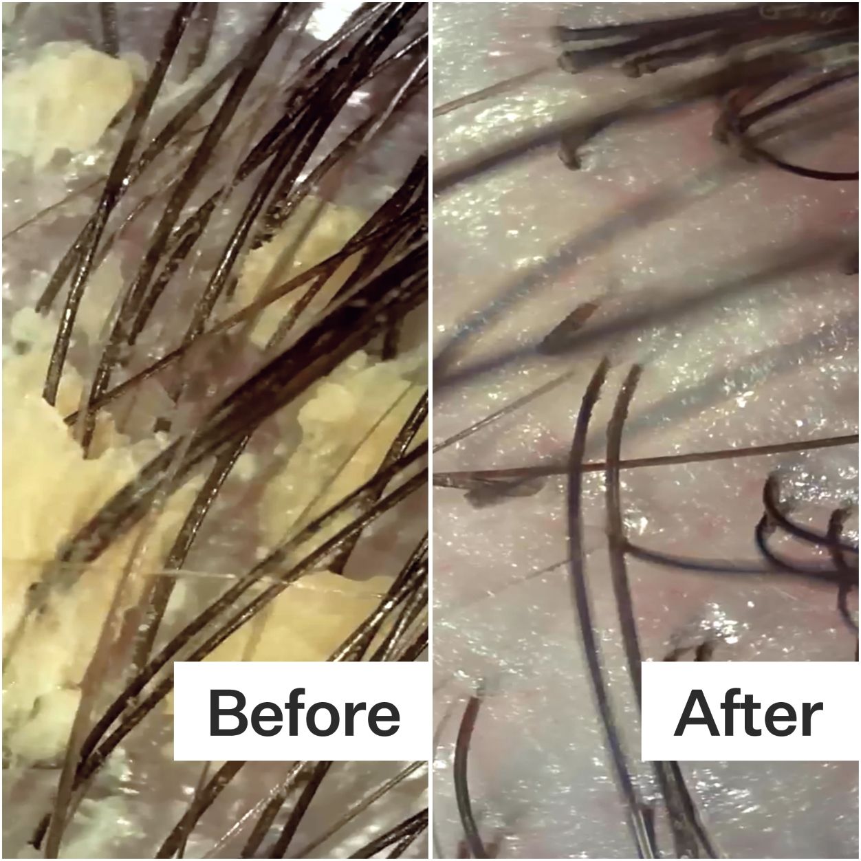 Before and after results of using Act+Acre Scalp Relief System