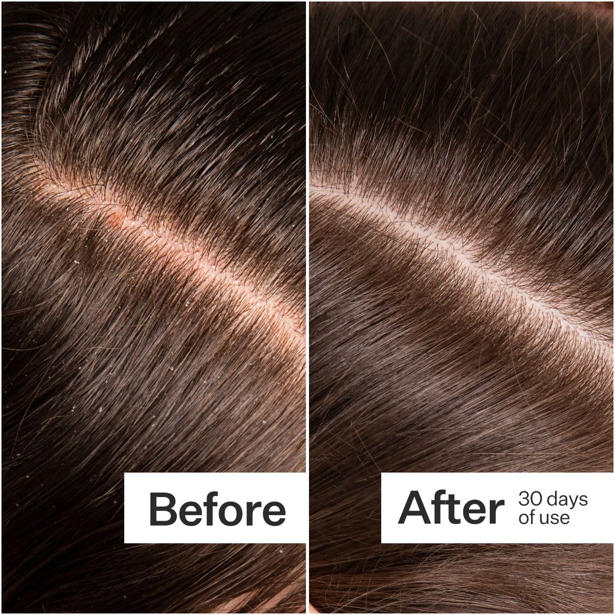 Before and after results of using Act+Acre Microbiome Cooling Scalp Serum