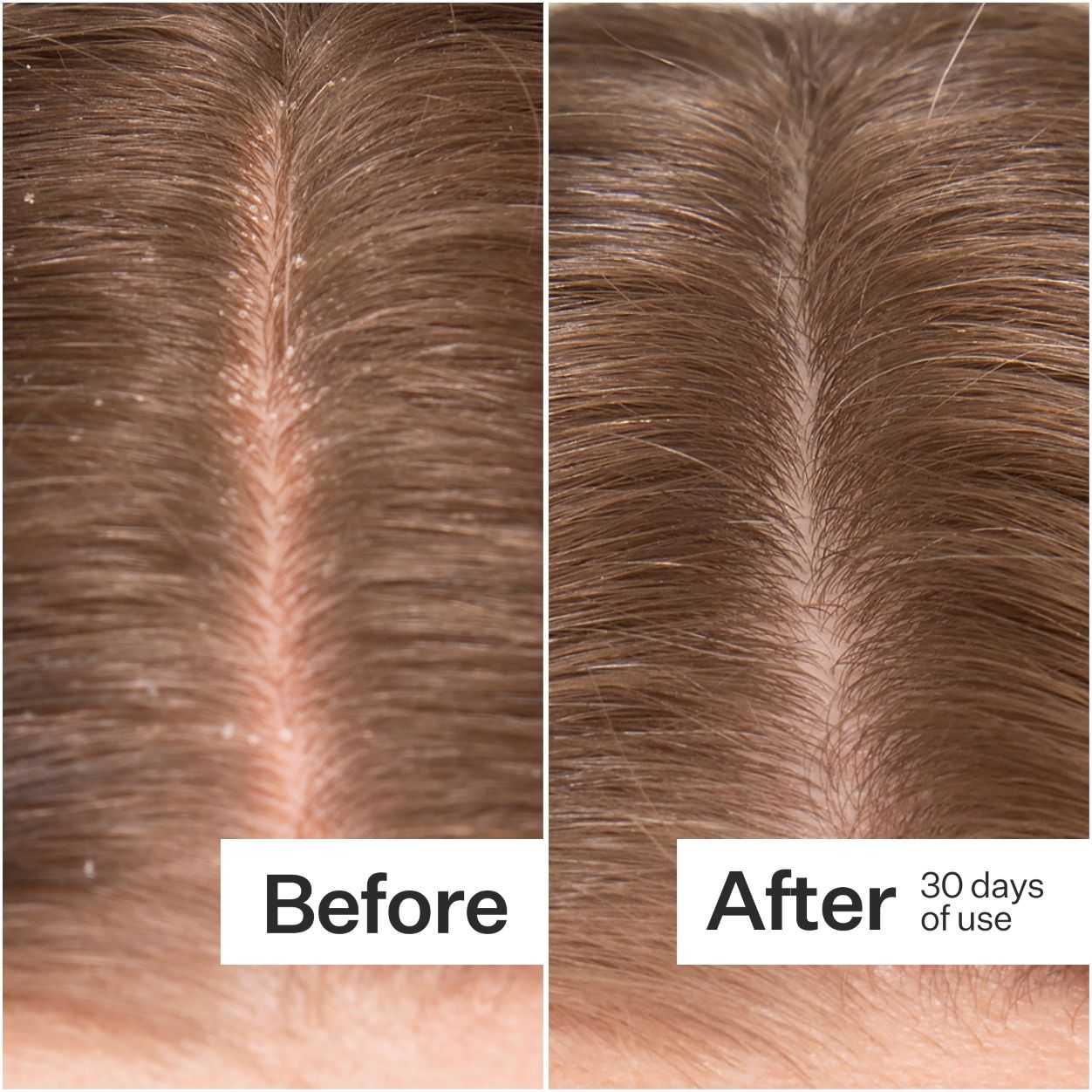 Before and after results of using Act+Acre Microbiome Cooling Scalp Serum