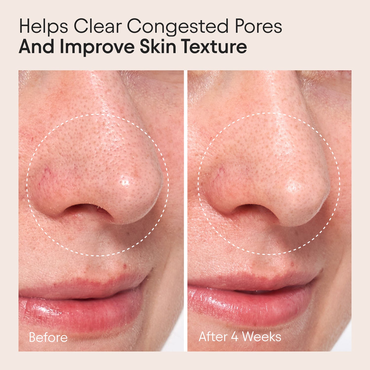 Before and after results of using Alpyn Beauty Clarifying Facial Oil with Retinol and Pink Algae