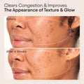 Before and after results of using Alpyn Beauty Clarifying Facial Oil with Retinol and Pink Algae