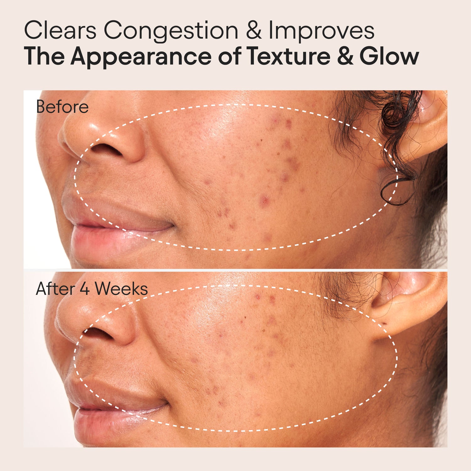 Before and after results of using Alpyn Beauty Clarifying Facial Oil with Retinol and Pink Algae