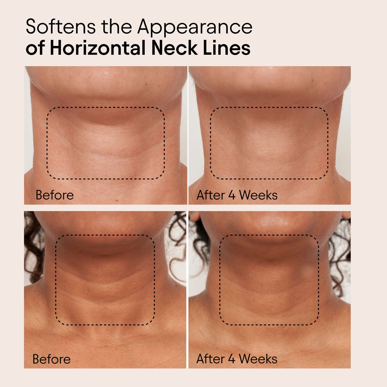 Before and after results of using Alpyn Beauty Super Sculpt Serum For Face and Neck with Tri-Peptide Firming Complex